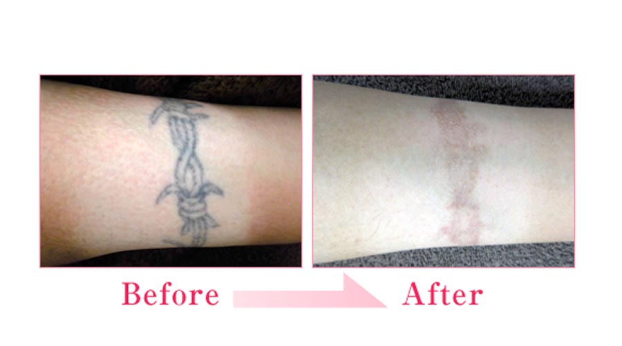 レーザー治療の色素沈着