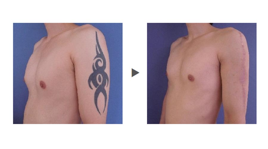 タトゥー除去方法の切除法