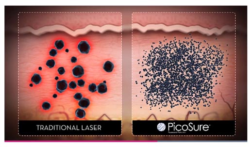 治療でレーザーがインクを粉砕するイメージ画像