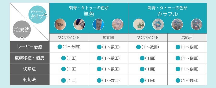 タトゥーの除去方法の一覧